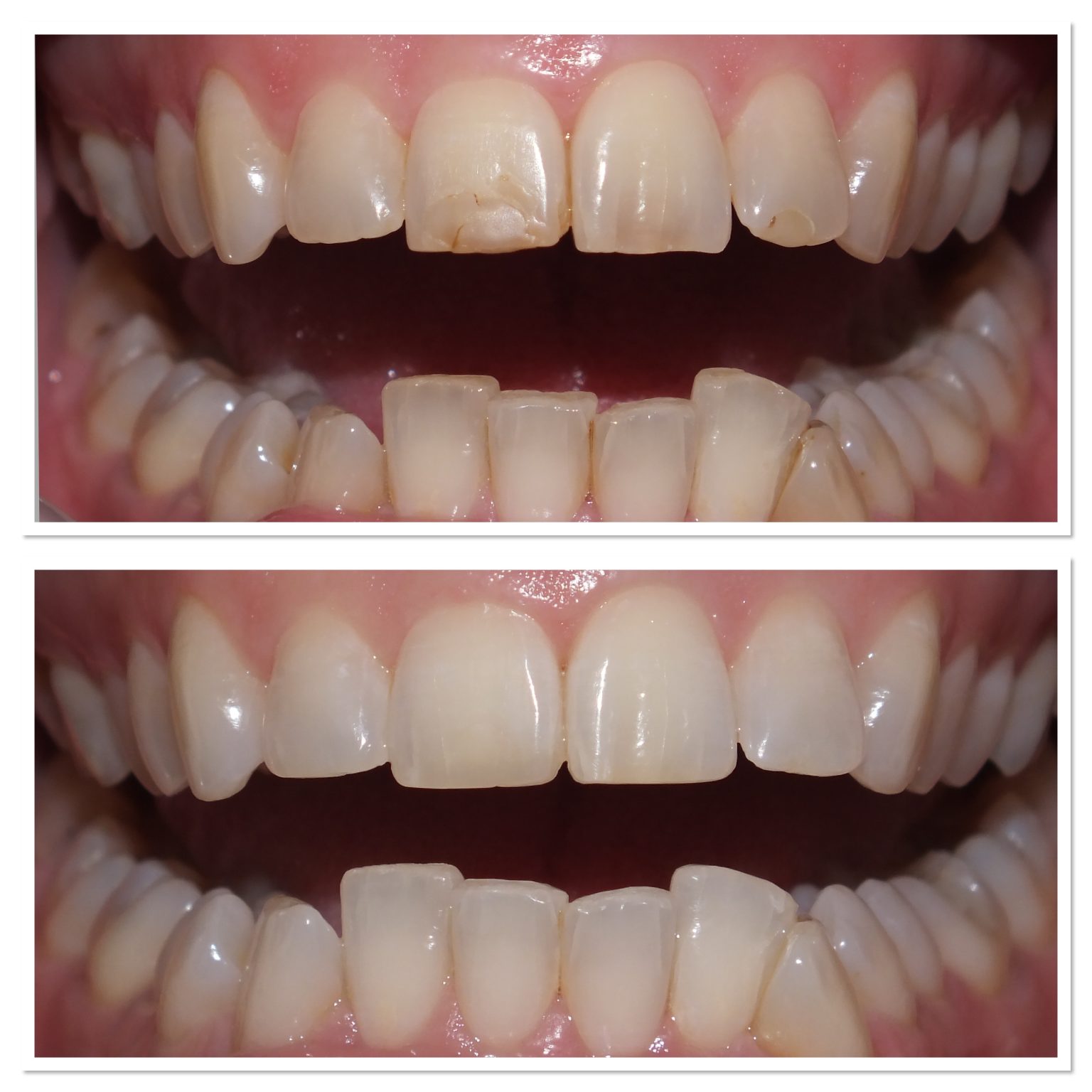 What is composite bonding....? Scarborough Dentist and Implant Clinic