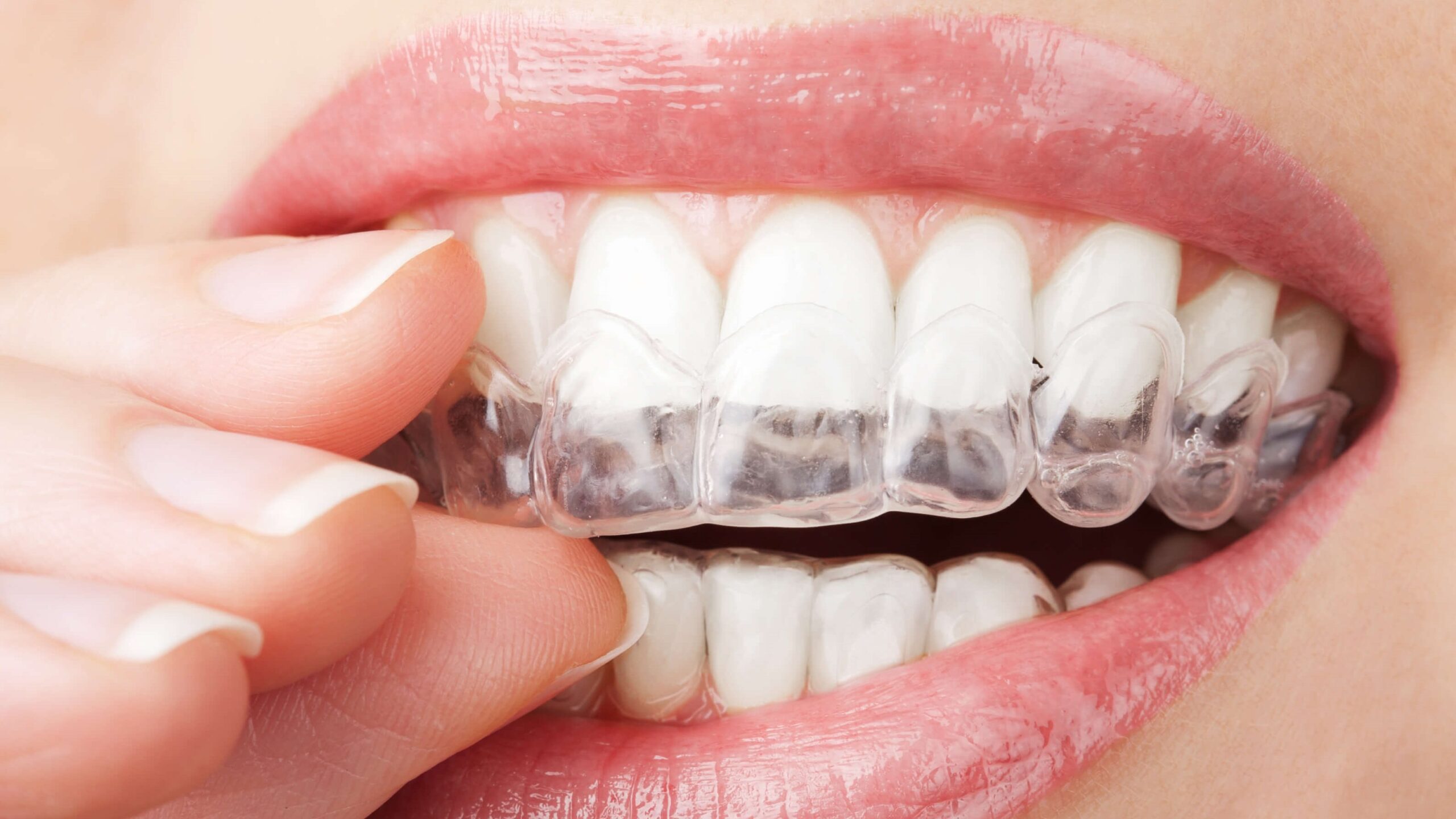 Invisalign Before and After – Doctor Emma