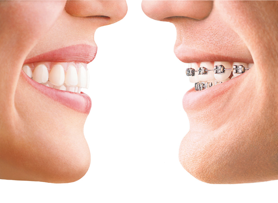 Invisalign for Overbite Correction: How It Works and What to Expect -  Family Dentistry & Aesthetics Inc.